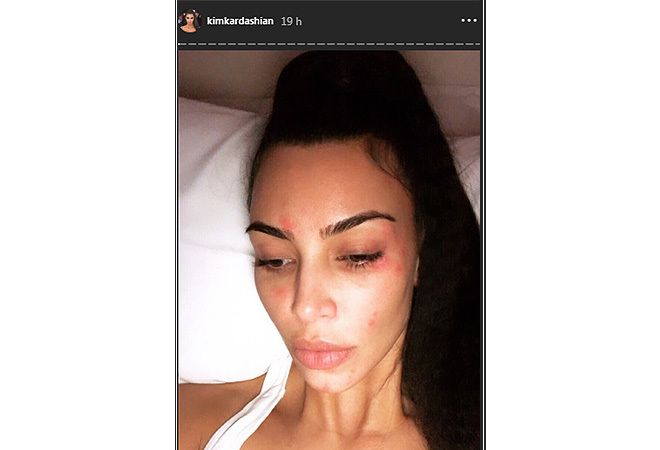 Kim Kardashian y su nuevo selfie con psoriasis