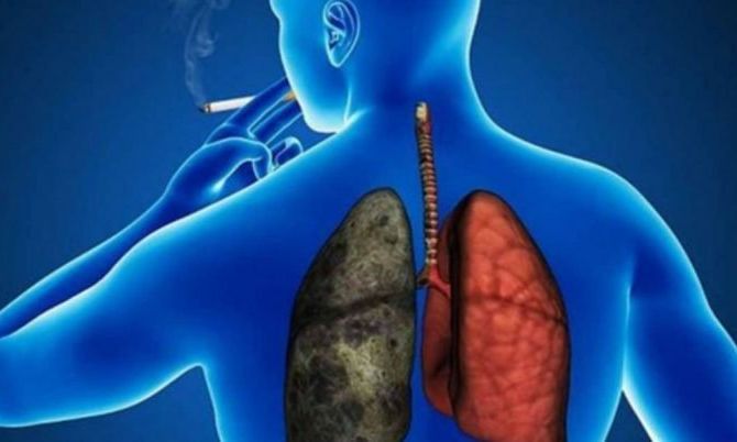 La ANMAT aprobó un tratamiento que elimina los rastros de cáncer de pulmón en el 80% de los casos