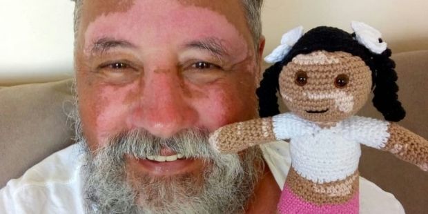 Un abuelo con vitíligo teje muñecas para los niños que padecen su misma enfermedad