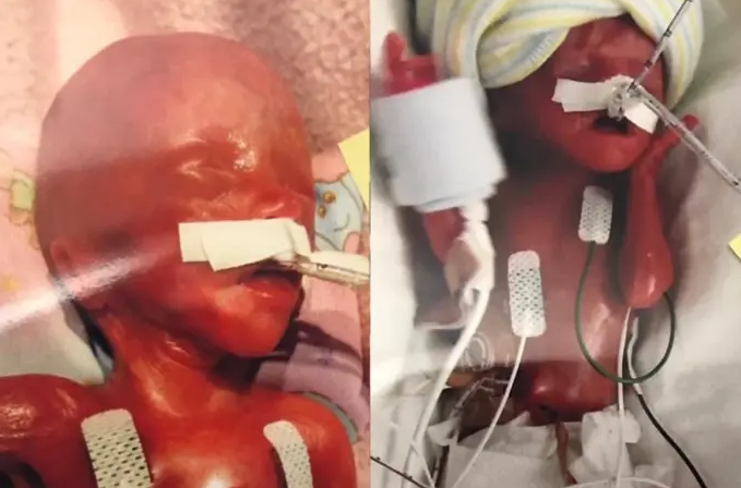 Así están hoy las gemelas más prematuras del mundo que nacieron con 155 días de gestación