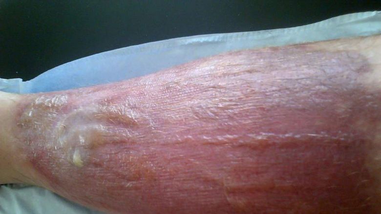 Reino Unido: preocupación por una gigantesca planta que produce severas lesiones en la piel