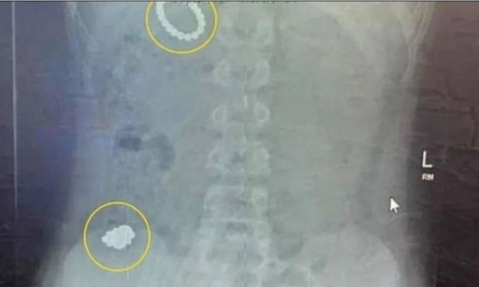 Un nene se tragó 54 imanes para volverse magnético y fue operado de urgencia