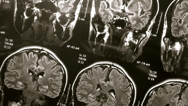 El líquido cefalorraquídeo da respuestas sobre la “niebla cerebral” de personas que sufren COVID-19