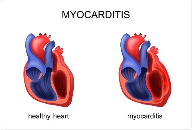 Covid-19: qué es la miocarditis y por qué la asocian con las vacunas