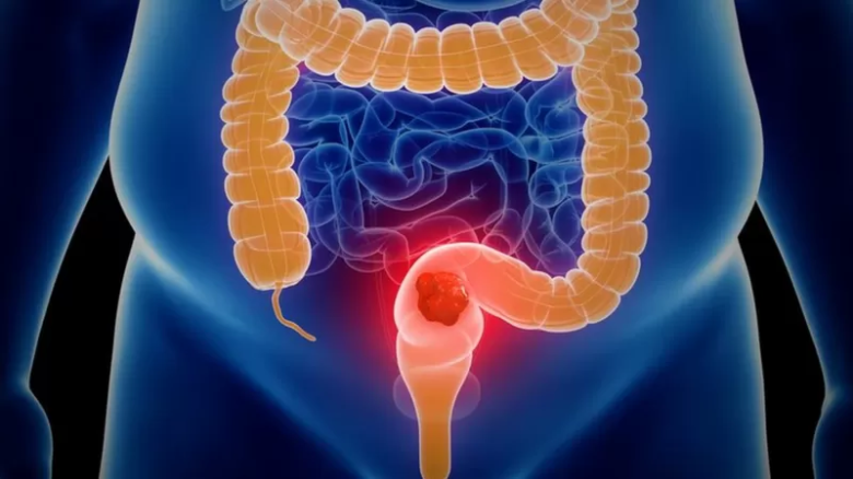 Cáncer de colon: cómo reconocer sus síntomas a tiempo 