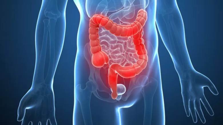Cáncer de colon: cómo reconocer sus síntomas a tiempo 