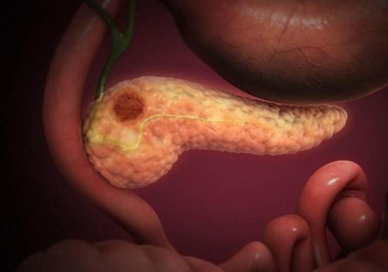 Los 14 síntomas que no debes ignorar del cáncer común más mortal, el de páncreas