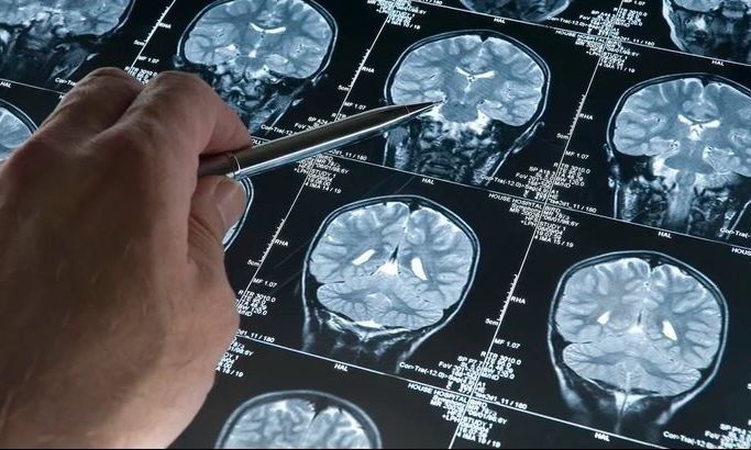 Alzheimer: aprueban un fármaco que demostró ralentizar el deterioro cognitivo