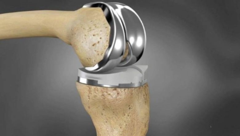 Argentinos estudian cómo disminuir los errores de los implantes óseos