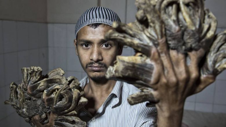 El ‘hombre árbol’ de Bangladés pierde la esperanza de curarse tras una veintena de operaciones