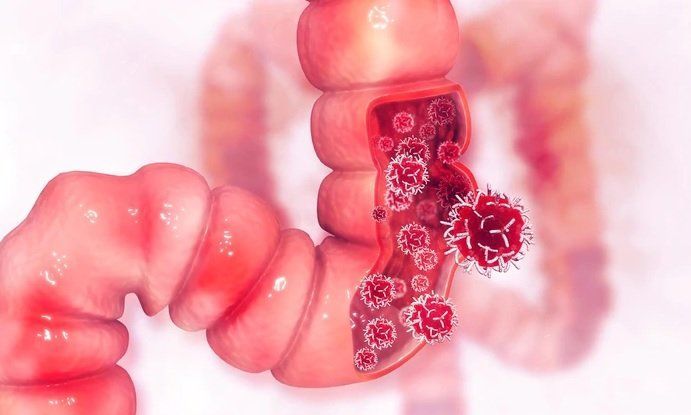 Cáncer de colon: causas y síntomas de la enfermedad que padece Fede Bal