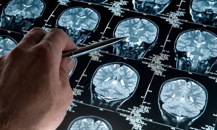 Un software de desarrollo argentino podría diagnosticar de forma precoz el Alzheimer